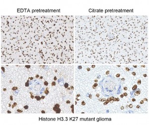 Immunostaining of brain tumor tissue sections using both EDTA and Citrate pretreatment methods. Clinically validated to be Positive for the H3.3 K27M Mutation by Sanger sequencing. Image courtesy of Sebastian Brandner MD, Division of Neuropathology and Dept. of Neurodegenerative Disease, UCL Institute of Neurology, London, UK