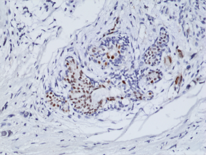 Immunohistochemical staining of formalin fixed and paraffin embedded human breast cancer tissue sections using Anti-ER-alpha Rabbit Monoclonal Antibody (Clone RM292) at a 1:100 dilution.