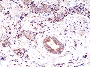 Immunohistochemical staining of formalin fixed and paraffin embedded human breast cancer tissue sections using anti-EGF Receptor rabbit monoclonal antibody (clone RM294) at a 1:200 dilution.
