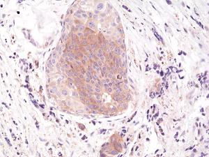Immunohistochemical staining of formalin fixed and paraffin embedded human breast cancer tissue section using anti-phospho-eIF-2alpha (Ser51) rabbit monoclonal antibody (clone RM298) at a 1:200 dilution.