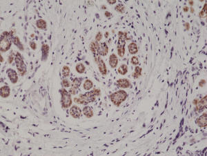 Immunohistochemical staining of formalin fixed and paraffin embedded human breast cancer tissue section using anti-S100B rabbit monoclonal antibody (Clone RM304) at a 1:1000 dilution.