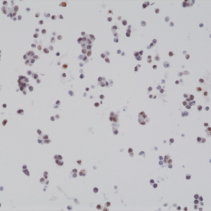 Immunohistochemical staining of formalin fixed and paraffin embedded 22RV1 cell section using anti-BAG-1L rabbit monoclonal antibody (Clone RM310) at a 1:2000 dilution.