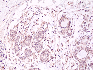 Immunohistochemical staining of formalin fixed and paraffin embedded human breast cancer tissue section using anti-AKT (PH domain) rabbit monoclonal antibody (Clone RM316) at a 1:500 dilution.