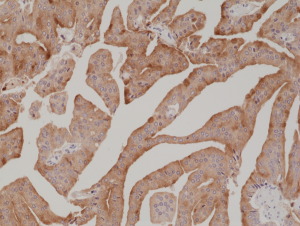 Immunohistochemical staining of formalin fixed and paraffin embedded human prostate cancer tissue section using anti-PSA rabbit monoclonal antibody (Clone RM323) at a 1:1000 dilution.