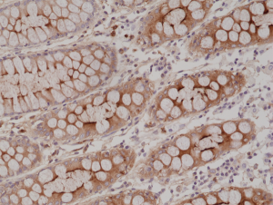 Immunohistochemical staining of formalin fixed and paraffin embedded human colon tissue section using anti-CEA rabbit monoclonal antibody (Clone RM326) at a 1:2000 dilution.