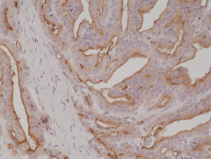 Immunohistochemical staining of formalin fixed and paraffin embedded human prostate cancer tissue section using anti-PSMA rabbit monoclonal antibody (Clone RM327) at a 1:1000 dilution.