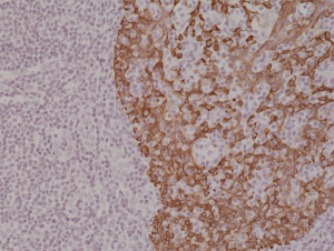 Immunohistochemical staining of formalin fixed and paraffin embedded human tonsil tissue section using anti-CK-14 rabbit monoclonal antibody (Clone RM328) at a 1:2000 dilution.