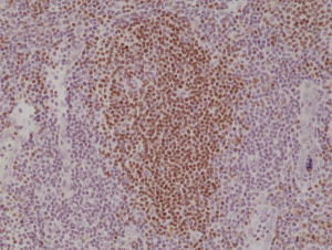 Immunohistochemical staining of formalin fixed and paraffin embedded human tonsil tissue section using anti-Paired box protein Pax-5 rabbit monoclonal antibody (Clone RM331) at a 1:1000 dilution.