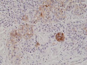 Immunohistochemical staining of formalin fixed and paraffin embedded human melanoma tissue section using anti-MART1 rabbit monoclonal antibody (Clone RM333) at a 1:1000 dilution.