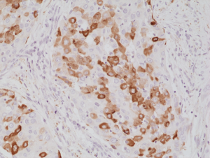 Immunohistochemical staining of formalin fixed and paraffin embedded human lung cancer tissue section using anti-Surfactant protein A (SP-A) rabbit monoclonal antibody (Clone RM334) at a 1:1000 dilution.