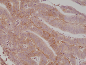 Immunohistochemical staining of formalin fixed and paraffin embedded human colon cancer tissue section using anti-CD276 (B7-H3) rabbit monoclonal antibody (Clone RM335) at a 1:1000 dilution.