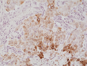 Immunohistochemical staining of formalin fixed and paraffin embedded human lung cancer tissue section using anti-COX-2 rabbit monoclonal antibody (Clone RM348) at a 1:1000 dilution.