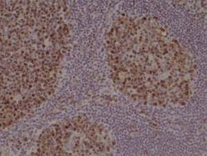 Immunohistochemical staining of formalin fixed and paraffin embedded human Tonsil tissue section using anti-Stathmin rabbit monoclonal antibody (Clone RM350) at a 1:1000 dilution.