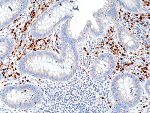 Immunohistochemical staining of formalin fixed and paraffin embedded human Appendix tissue section using anti-MUM1/IRF4 rabbit monoclonal antibody (Clone RM352) at a 1:800 dilution.