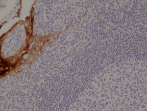 Immunohistochemical staining of formalin fixed and paraffin embedded human tonsil tissue section using anti-CK-4 rabbit monoclonal antibody (Clone RM355) at a 1:1000 dilution.