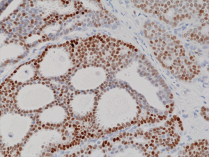 Immunohistochemical staining of formalin fixed and paraffin embedded human breast cancer tissue sections using Anti-Progesterone Receptor (PR) Rabbit Monoclonal Antibody (Clone RM357) at a 1:100 dilution.