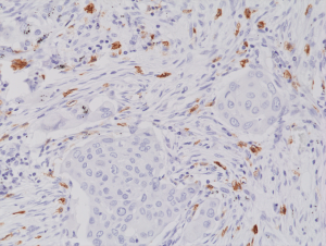 Immunohistochemical staining of formalin fixed and paraffin embedded human lung cancer tissue section using anti-CD117/c-Kit rabbit monoclonal antibody (Clone RM359) at a 1:2000 dilution.