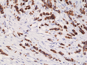 Immunohistochemical staining of formalin fixed and paraffin embedded human breast cancer tissue section using anti-CK-19 rabbit monoclonal antibody (Clone RM364) at a 1:1000 dilution.