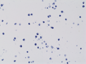Immunohistochemical staining of formalin fixed and paraffin embedded 293T cells transfected with a DNA construct encoding wild type (WT) proteins of Histone H3, stained with anti-Histone H3 K4M rabbit monoclonal antibody clone RM363.