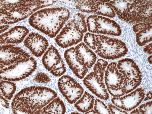 Immunohistochemical staining of formalin fixed and paraffin embedded human colon cancer tissue section using anti-SATB2 rabbit monoclonal antibody (Clone RM365) at a 1:1000 dilution.