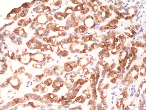 Immunohistochemical staining of formalin fixed and paraffin embedded human thyroid tissue section using anti-TPO rabbit monoclonal antibody (Clone RM368) at a 1:1000 dilution.