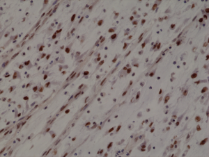 Immunohistochemical staining of formalin fixed and paraffin embedded human Rhabdomyosarcoma section using anti-MyoD1 rabbit monoclonal antibody (Clone RM369) at a 1:1000 dilution.