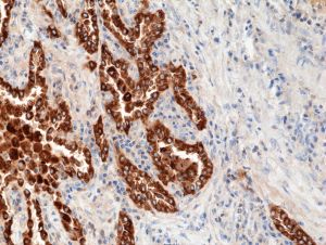 Immunohistochemical staining of formalin fixed and paraffin embedded human lung cancer tissue section using anti-SP-B rabbit monoclonal antibody (Clone RM370) at a 1:1000 dilution.