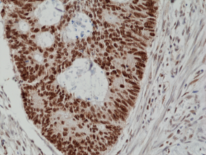 Immunohistochemical staining of formalin fixed and paraffin embedded human colon cancer tissue section using anti-MSH2 rabbit monoclonal antibody (Clone RM375) at a 1:200 dilution.