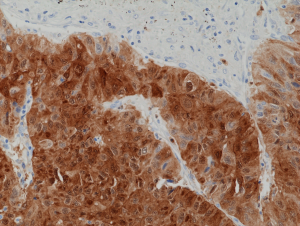 Immunohistochemical staining of formalin fixed and paraffin embedded human liver cancer tissue section using anti-ARG1 rabbit monoclonal antibody (Clone RM377) at a 1:1250 dilution.