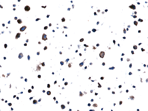Immunohistochemical staining of formalin fixed and paraffin embedded H1975 cell section using Anti-EGFR(L858R) Rabbit Monoclonal Antibody (Clone RM380) at a 1:100 dilution.