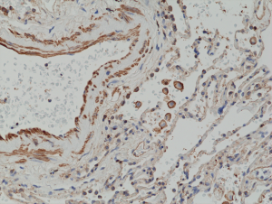 Immunohistochemical staining of formalin fixed and paraffin embedded human lung tissue section using anti-MMP-12 rabbit monoclonal antibody (Clone RM381) at a 1:2500 dilution.