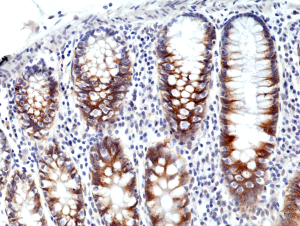 Immunohistochemical staining of formalin fixed and paraffin embedded human colon cancer tissue section using anti-CD71 rabbit monoclonal antibody (Clone RM384) at a 1:500 dilution.