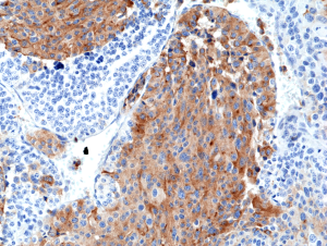 Immunohistochemical staining of formalin fixed and paraffin embedded Medullary Thyroid Carcinoma tissue section using anti-Chromogranin A rabbit monoclonal antibody (Clone RM385) at a 1:2500 dilution.