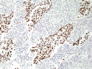 Immunohistochemical staining of formalin fixed and paraffin embedded human lung cancer tissue section using anti-p53 rabbit monoclonal antibody (Clone RM 387) at a 1:100 dilution.