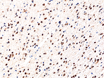 Immunohistochemical staining of formalin fixed and paraffin embedded human glioblastoma using Anti-IDH1(R132H) Rabbit Monoclonal Antibody (Clone RM390) at a 1:100 dilution.