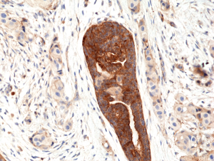 Immunohistochemical staining of formalin fixed and paraffin embedded human breast cancer tissue section using anti-VEGF rabbit monoclonal antibody (Clone RM391) at a 1:100 dilution.