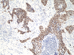 Immunohistochemical staining of formalin fixed and paraffin embedded human lung squamous carcinoma tissue section using anti-p40(deltaNp63) rabbit monoclonal antibody (Clone RM392) at a 1:50 dilution.