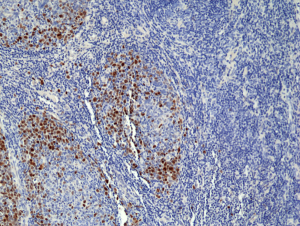 Immunohistochemical staining of formalin fixed and paraffin embedded human tonsil tissue section using anti-TOP2A rabbit monoclonal antibody (Clone RM 394) at a 1:100 dilution.