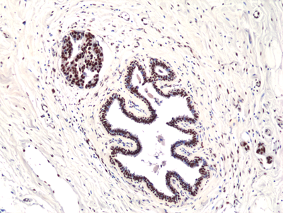 Immunohistochemical staining of formalin fixed and paraffin embedded human Glioblastoma Multiforme tissue sections with or without EGFRvIIII using anti-EGFRvIII antibody (RM419) at 1:100 dilution.