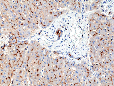 Immunohistochemical staining of formalin fixed and paraffin embedded breast ductal carcinoma section using Anti-Foxp1 Rabbit Monoclonal Antibody (Clone RM402) at a 1:200 dilution.
