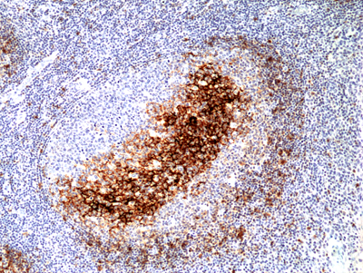 Immunohistochemical staining of formalin fixed and paraffin embedded human colon cancer tissue section using Anti-MSH3 Rabbit Monoclonal Antibody (Clone RM405) at a 1:200 dilution.