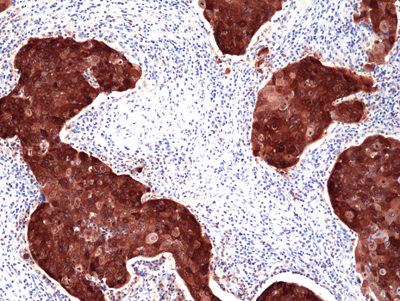 Immunohistochemical staining of formalin fixed and paraffin embedded human tonsil tissue section using Anti-ZAP70 Rabbit Monoclonal Antibody (Clone RM408) at a 1:200 dilution.