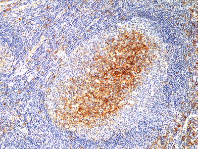 Immunohistochemical staining of formalin fixed and paraffin embedded human cervical squamous carcinoma tissue section using Anti-p16 Rabbit Monoclonal Antibody (Clone RM409) at a 1:200 dilution.