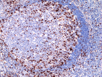 Immunohistochemical staining of formalin fixed and paraffin embedded human lung adenocarcinoma tissue section using anti-CK-7 rabbit monoclonal antibody (Clone RM416) at a 1:100 dilution.