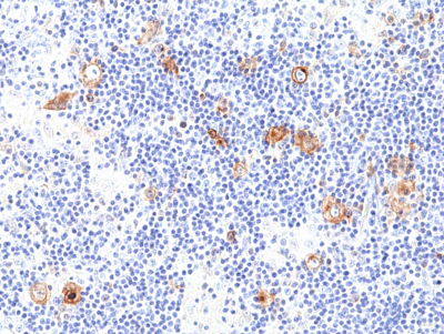 Immunohistochemical staining of formalin fixed and paraffin embedded human Hodgkins lymphoma tissue section using anti- CD30 rabbit monoclonal antibody (Clone RM425) at a 1:100 dilution.