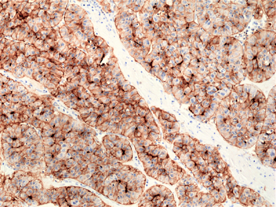 Immunohistochemical staining of formalin fixed and paraffin embedded human liver cancer tissue section using anti-CD73 rabbit monoclonal antibody (Clone RM431) at a 1:200 dilution.