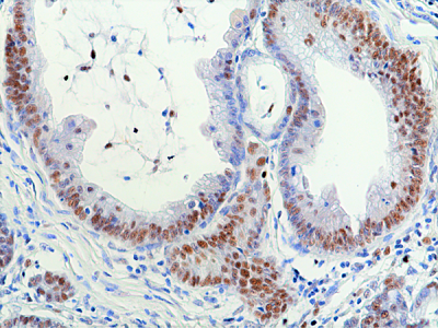Immunohistochemical staining of formalin fixed and paraffin embedded human colon cancer tissue sections using anti-RNASEH2B antibody (RM433) at 1:100 dilution.,Immunohistochemical staining of formalin fixed and paraffin embedded human lung cancer tissue sections using anti-RNASEH2B antibody (RM433) at 1:100 dilution.