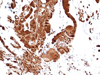 Immunohistochemical staining of formalin fixed and paraffin embedded human colon cancer tissue sections using Anti-Erk1 antibody (RM470) at 1:100 dilution.