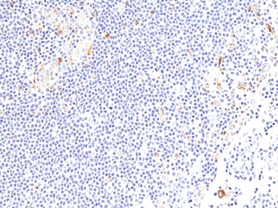 Immunohistochemical staining of formalin fixed and paraffin embedded Hodgkin's lymphoma tissue sections using Anti-CD137 antibody (RM471) at 1:100 dilution.
