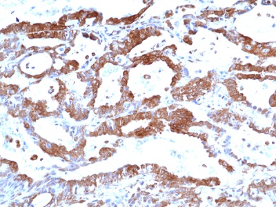 Immunohistochemical staining of formalin fixed and paraffin embedded human lung cancer tissue sections using Anti-FAK antibody (RM472) at 1:100 dilution.